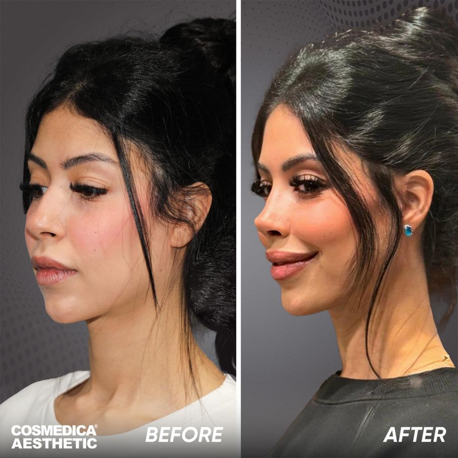 Before and after rhinoplasty results at Cosmedica Aesthetic Clinic Istanbul, showing a female patient with a refined, natural-looking nose profile after surgery.